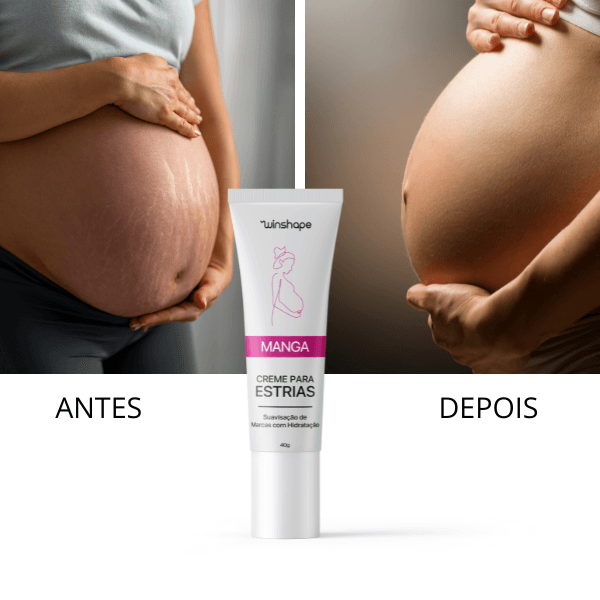 Creme Anti-estrias Natural: Previna e Reduza Marcas de Estrias