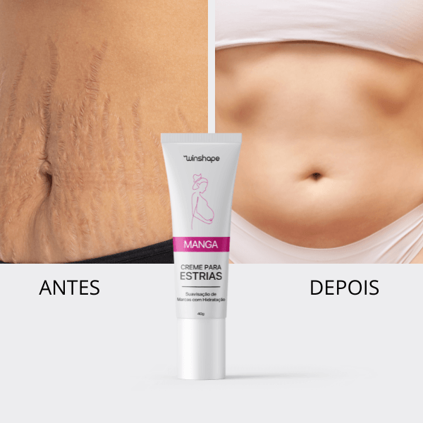 Creme Anti-estrias Natural: Previna e Reduza Marcas de Estrias
